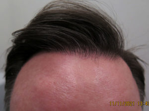 Hair Transplant