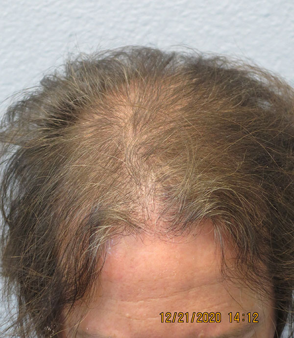 Hair Transplant