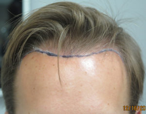 Hair Transplant