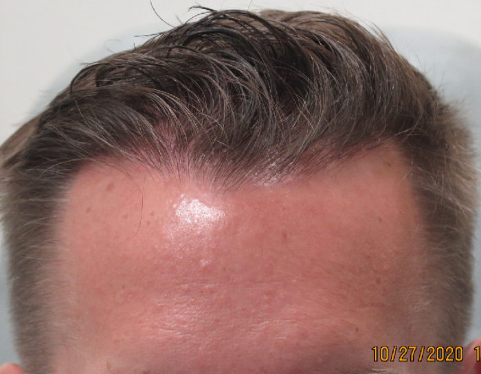 Hair Transplant