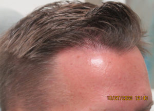 Hair Transplant