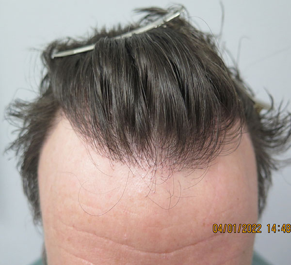 Hair Transplant