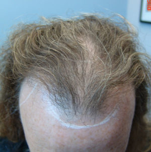 Hair Transplant