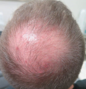 Hair Transplant