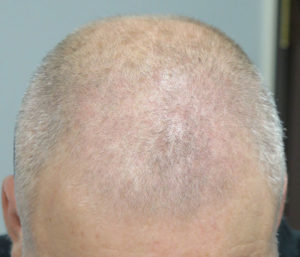 Hair Transplant