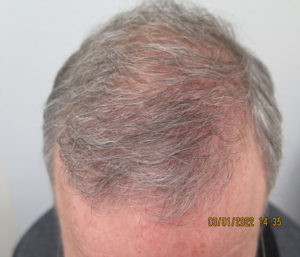 Hair Transplant