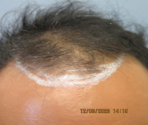 Hair Transplant