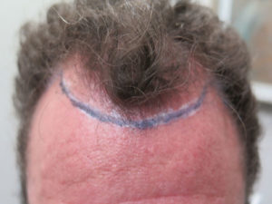 Hair Transplant