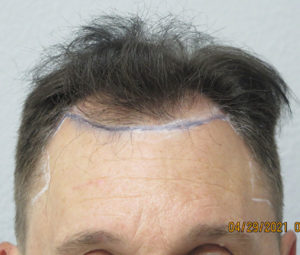 Hair Transplant