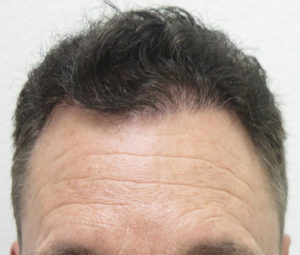 Hair Transplant