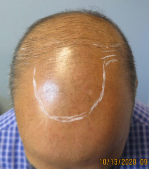 Hair Transplant