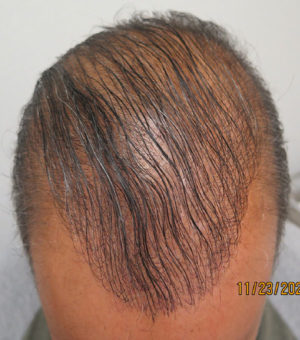 Hair Transplant