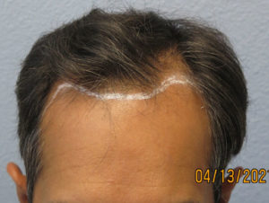 Hair Transplant