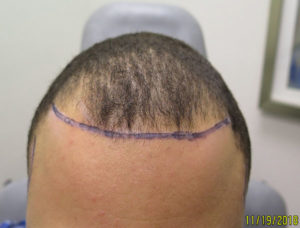 Hair Transplant