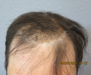 Hair Transplant