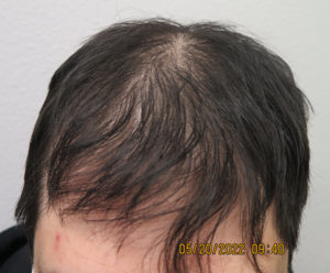 Hair Transplant