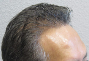 Hair Transplant