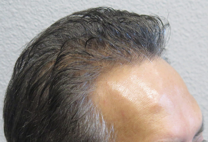 Hair Transplant