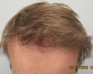 Hair Transplant