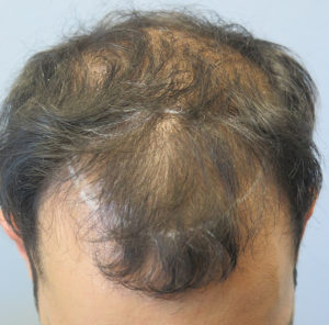 Hair Transplant