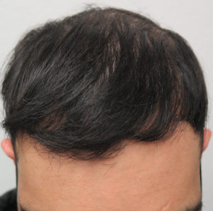 Hair Transplant