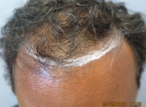 Hair Transplant