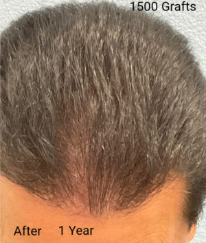 Hair Transplant