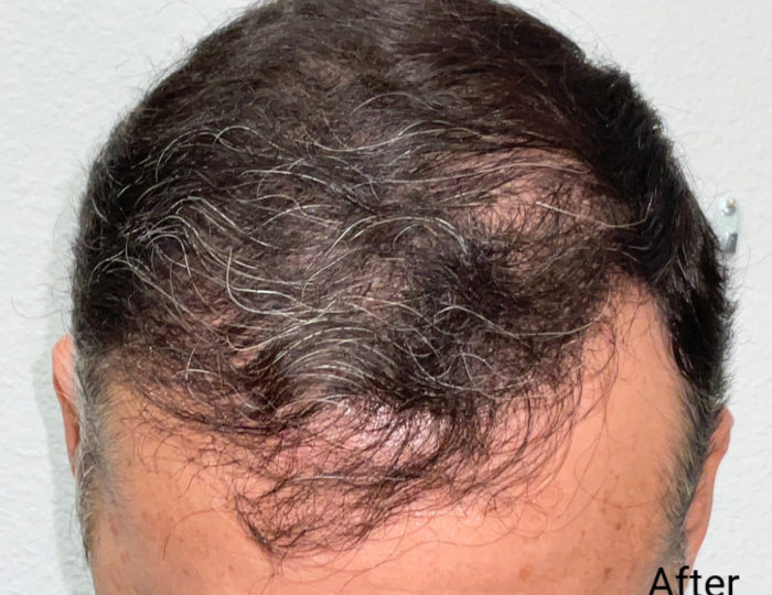 Hair Transplant