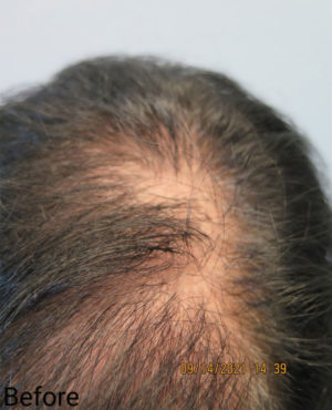 Hair Transplant