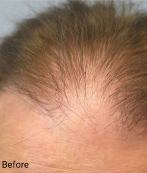 Hair Transplant