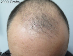 Hair Transplant