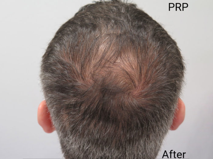 PRP Scalp Injections