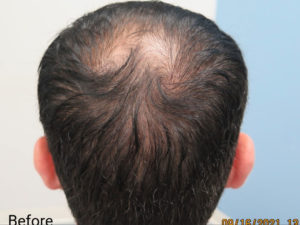 PRP Scalp Injections