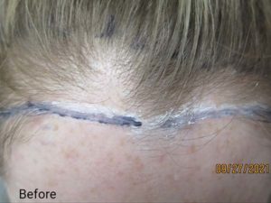 Hair Transplant