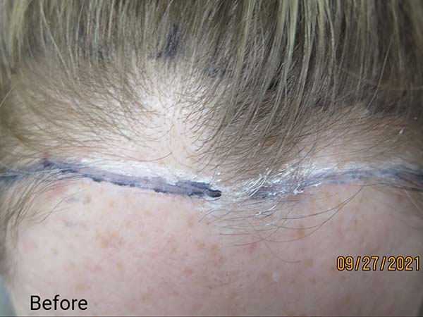 Hair Transplant