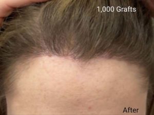 Hair Transplant