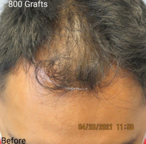 Hair Transplant