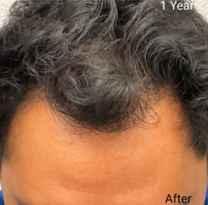 Hair Transplant