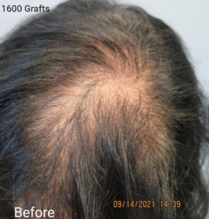 Hair Transplant