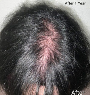 Hair Transplant