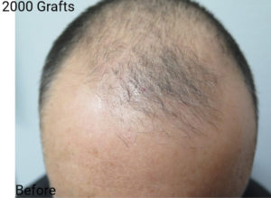 Hair Transplant