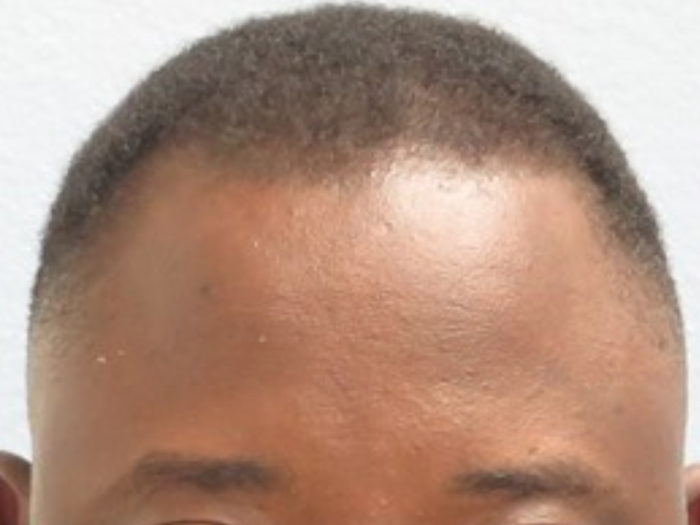 Hair Transplant