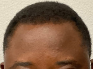 Hair Transplant