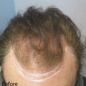 Hair Transplant