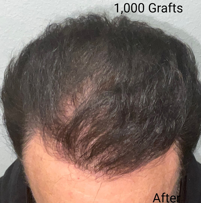 Hair Transplant