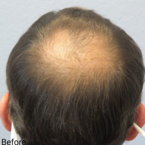 Hair Transplant
