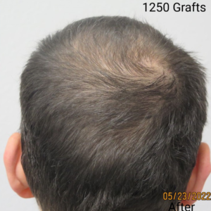 Hair Transplant