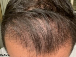 Hair Transplant