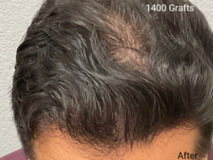 Hair Transplant