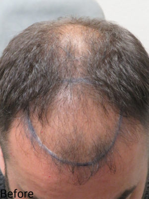 Hair Transplant